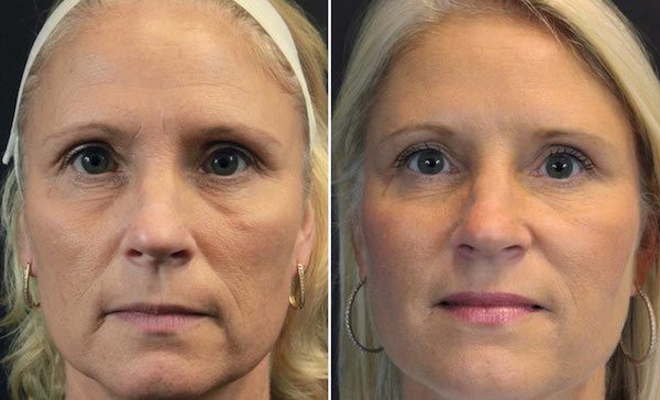 thread facelift before and after 1