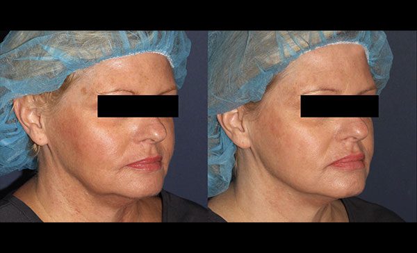 thread facelift before and after 2