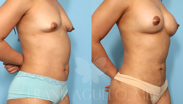 Breast Revision Before and After 10