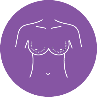 Implant Removal and Breast Lift
