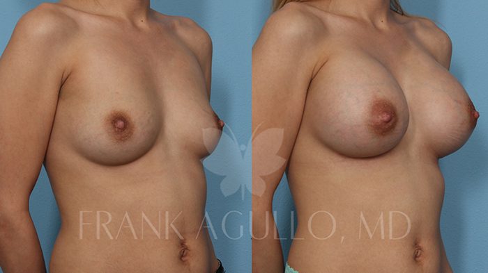 Breast Before and After 18