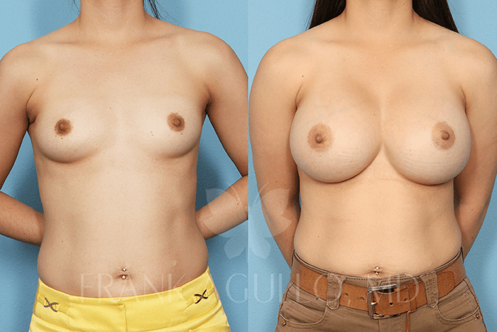 Breast Augmentation Before and After 10