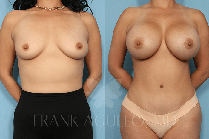 Breast Augmentation Before and After 8