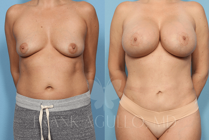 Breast Augmentation Before and After 2