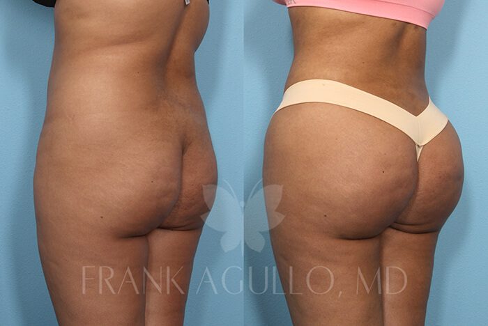Brazilian Butt Lift Before and After 5