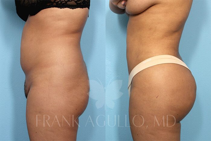 Brazilian Butt Lift Before and After 4