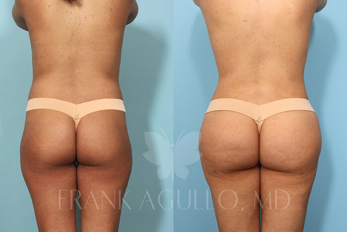 Brazilian Butt Lift Before and After 2
