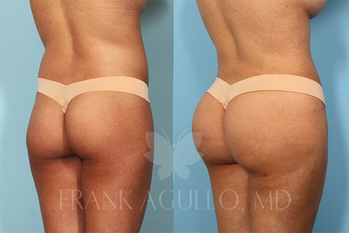 Brazilian Butt Lift Before and After 2