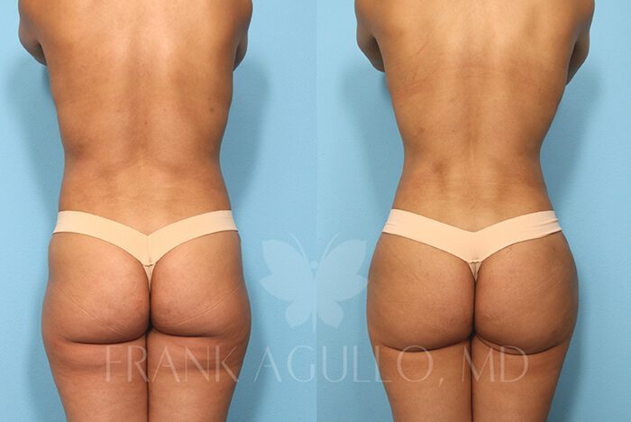 Brazilian Butt Lift Before and After 12