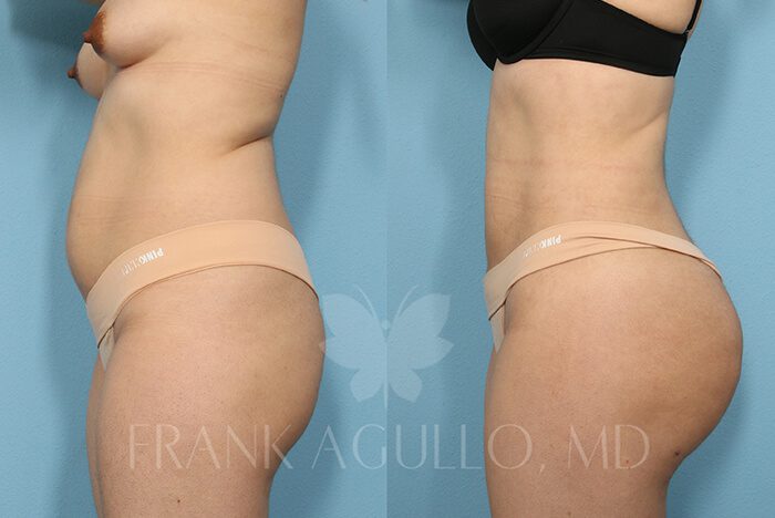 Brazilian Butt Lift Before and After 11