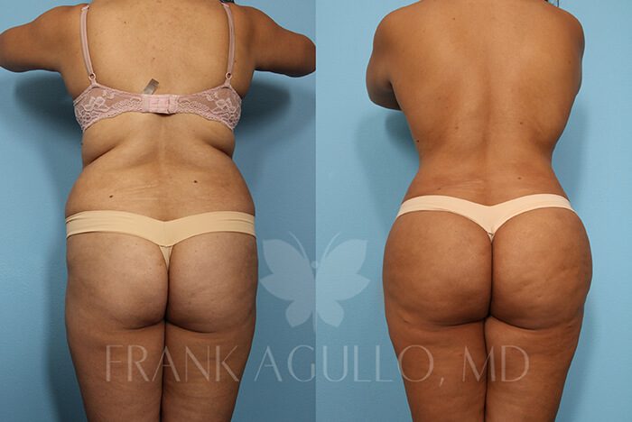 Brazilian Butt Lift Before and After 10