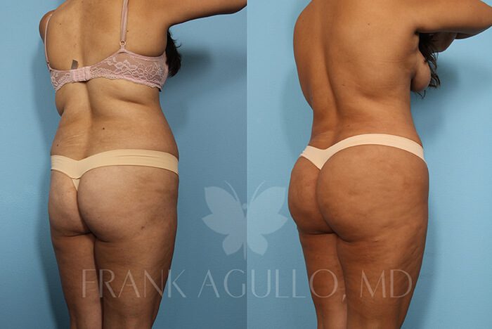 Brazilian Butt Lift Before and After 2