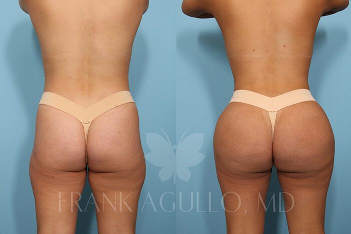 Brazilian Butt Lift Before and After 9