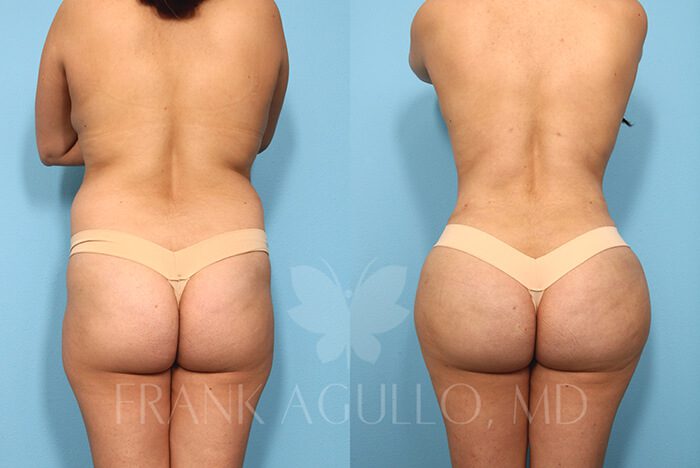 Brazilian Butt Lift Before and After 7