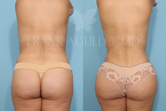 Brazilian Butt Lift Before and After 6