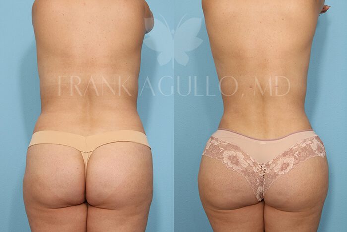 Brazilian Butt Lift Before and After 15