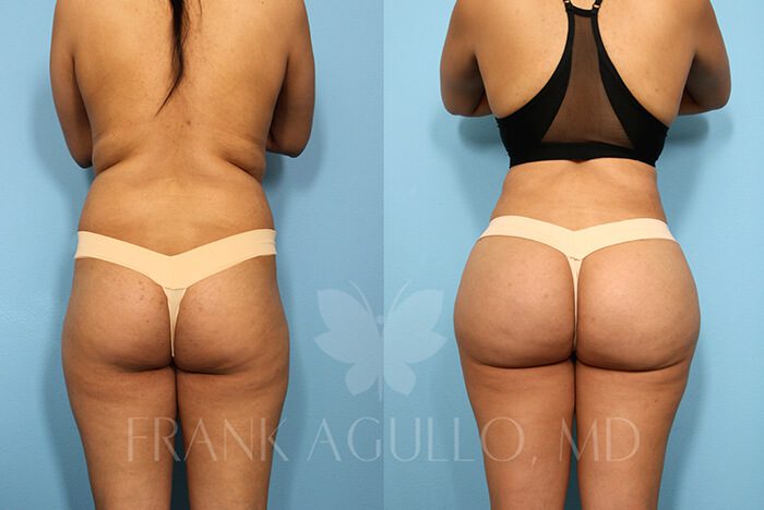 Before & After Photos  Brazilian Butt Lift Patient 62 - Frank Agullo, MD