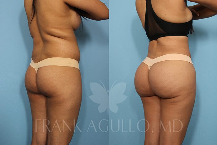 Brazilian Butt Lift Before and After 2