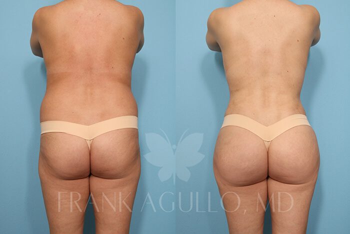 Brazilian Butt Lift Before and After 4
