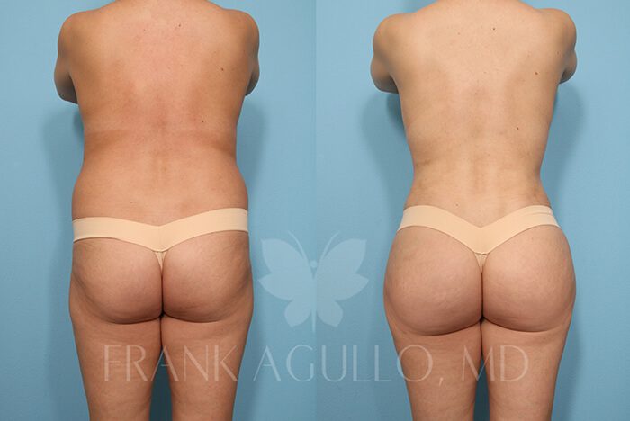 Brazilian Butt Lift Before and After 13