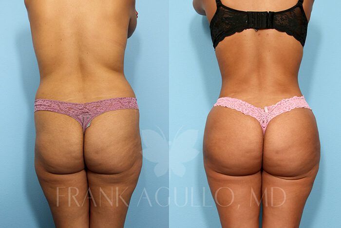 Brazilian Butt Lift Before and After 1