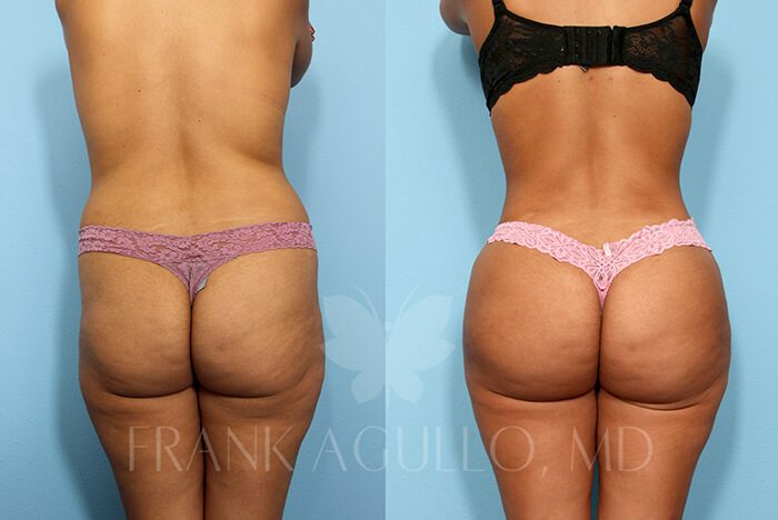 Brazilian Butt Lift Before and After 10