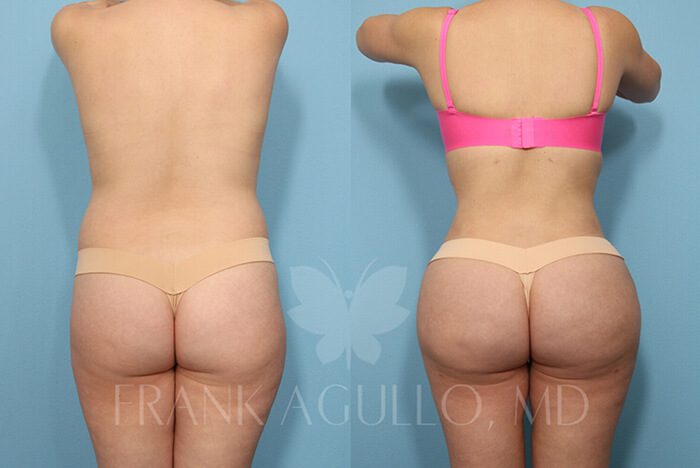 Brazilian Butt Lift Before and After 9