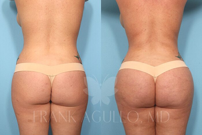 Brazilian Butt Lift Before and After 19