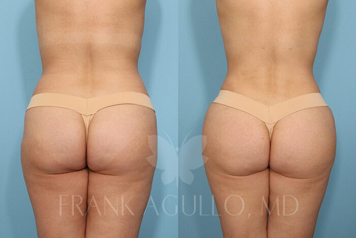 Brazilian Butt Lift Before and After 17