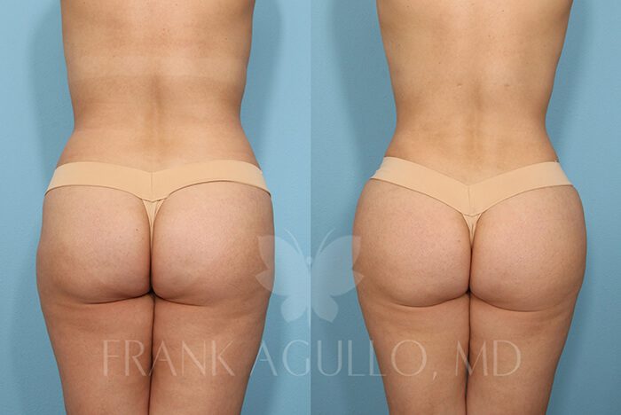 Brazilian Butt Lift Before and After 6