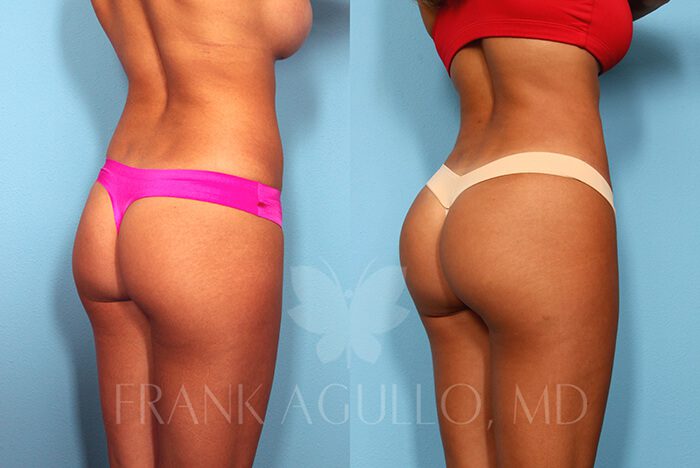 Brazilian Butt Lift Before and After 2