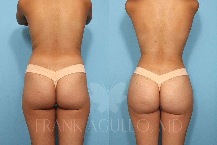 Brazilian Butt Lift Before and After 4