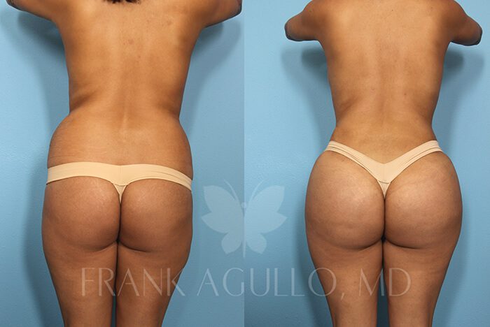 Brazilian Butt Lift Before and After 14