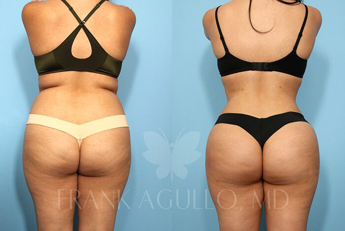 Brazilian Butt Lift Before and After 2