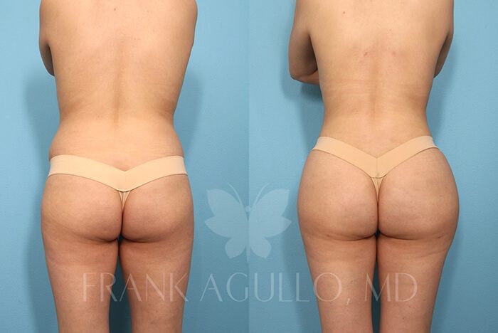 Brazilian Butt Lift Before and After 11
