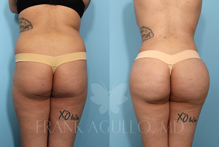 Brazilian Butt Lift Before and After 9