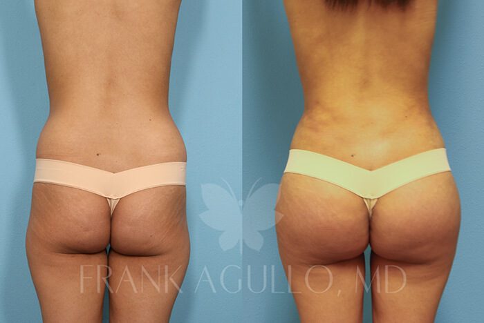 Brazilian Butt Lift Before and After 4