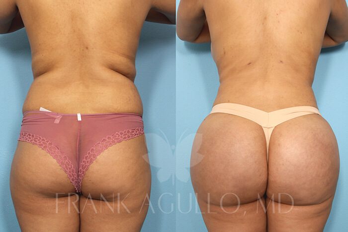 Brazilian Butt Lift Before and After 3