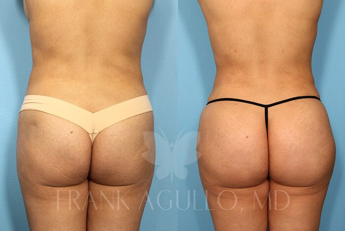 Brazilian Butt Lift Before and After 2