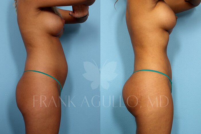 Brazilian Butt Lift Before and After 9