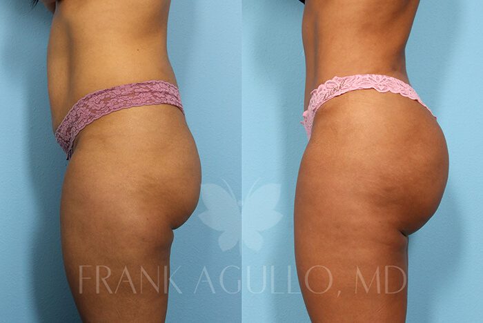 Brazilian Butt Lift Before and After 6