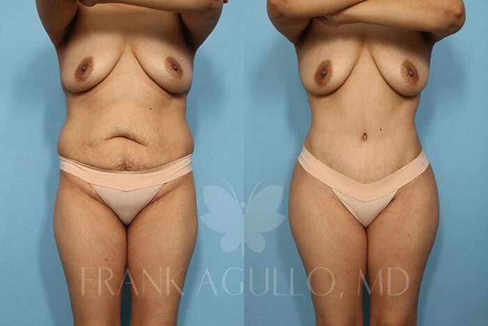 Brazilian Butt Lift Before and After 14