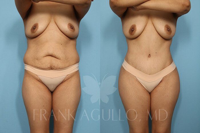 Brazilian Butt Lift Before and After 3