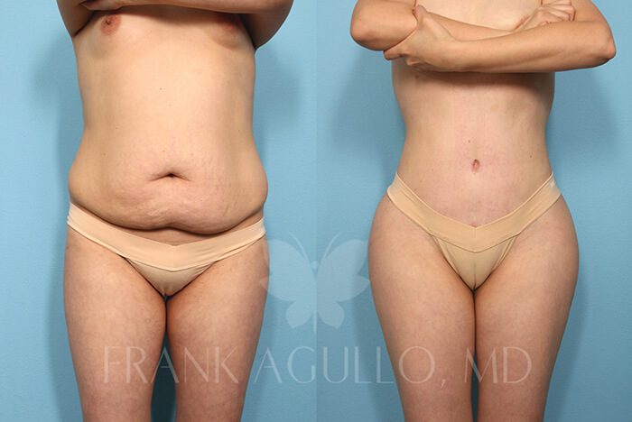 Brazilian Butt Lift Before and After 1
