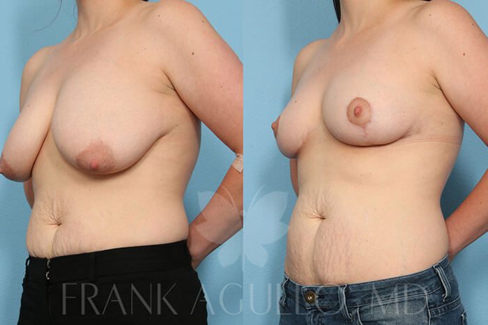 Breast Reduction Before and After 2