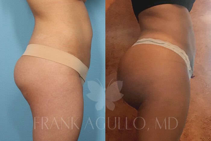 Butt Implants Before and After 16