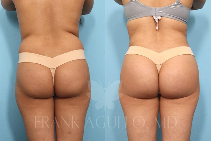 Butt Implants Before and After 14