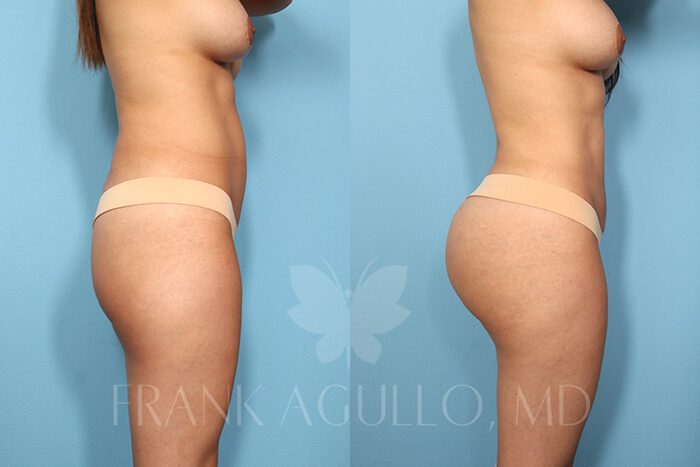 Butt Implants Before and After 4