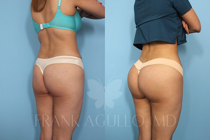 Butt Implants Before and After 12