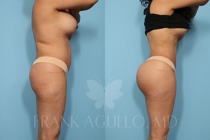 Butt Implants Before and After 3